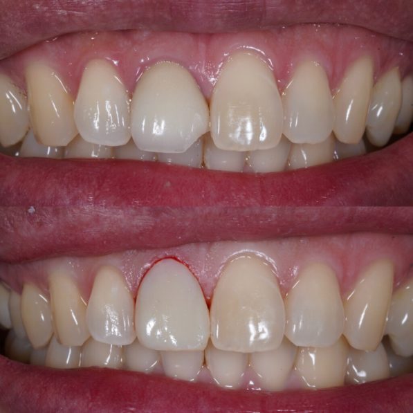 Before,:,Fracture,Dental,Crown,,,After,:,Temporary,Crown